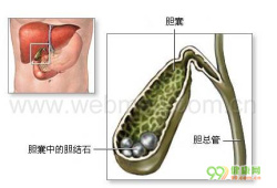 胆结石